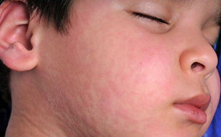 Allergic skin rash - a symptom of the presence of parasitic worms in the body